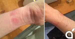 Apple Watch causes skin allergy, Apple says users may not be wearing it properly