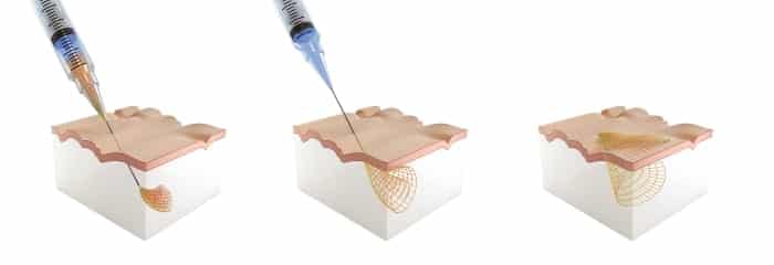 Researches say electronics directly injected into brain can cure paralysis and other neuro diseases - 45