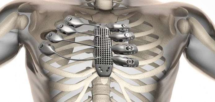 Cancer patient receives 3D-printed titanium sternum and rib cage