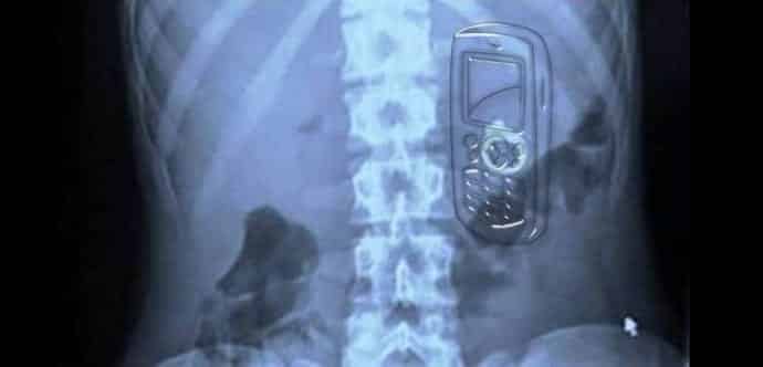 Man swallows a cellphone, gets operated