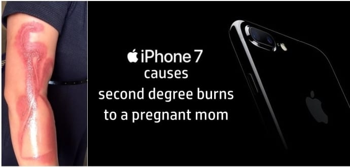 Not A Tattoo, Pregnant Mom Gets Second Degree Burns From Her iPhone 7