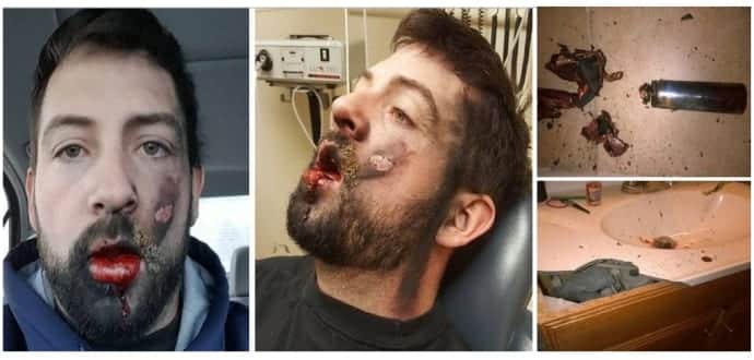 E-cig explodes in an Idaho man’s face, loses 7 teeth and suffers second degree burns