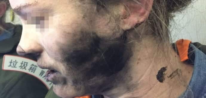 Woman’s battery-operated headphones explode mid-flight, suffers burn injuries