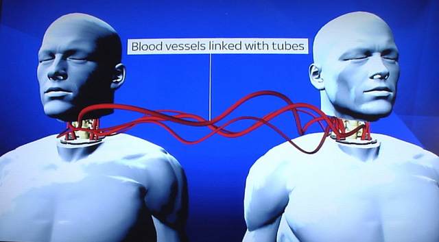 World's first head transplant to happen early next year